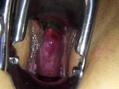 Deep view inside woman with speculum, nice view of cervix