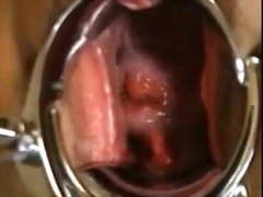 Japanese Extreme EW cervix, speculum, close-up